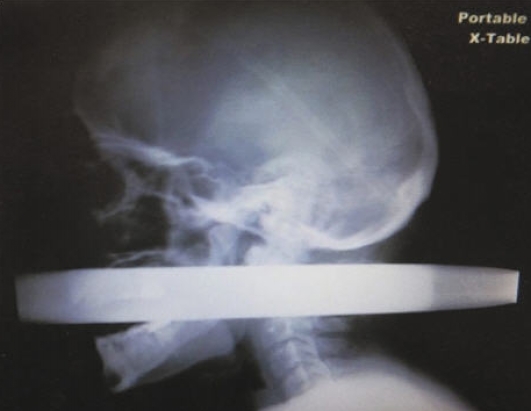 Docs save man after bullet pierces through his skull